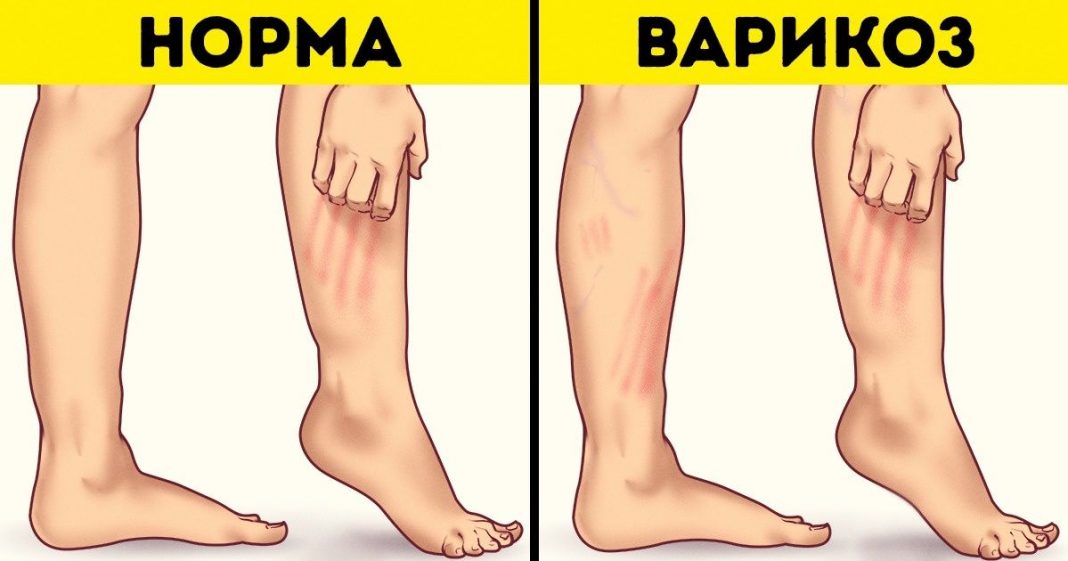 Варикоз 1 Степени Лечение Народными Средствами