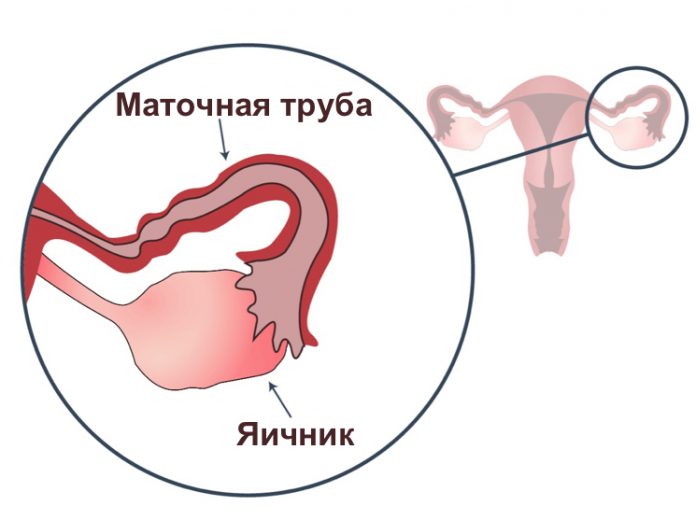 Больные маточные трубы